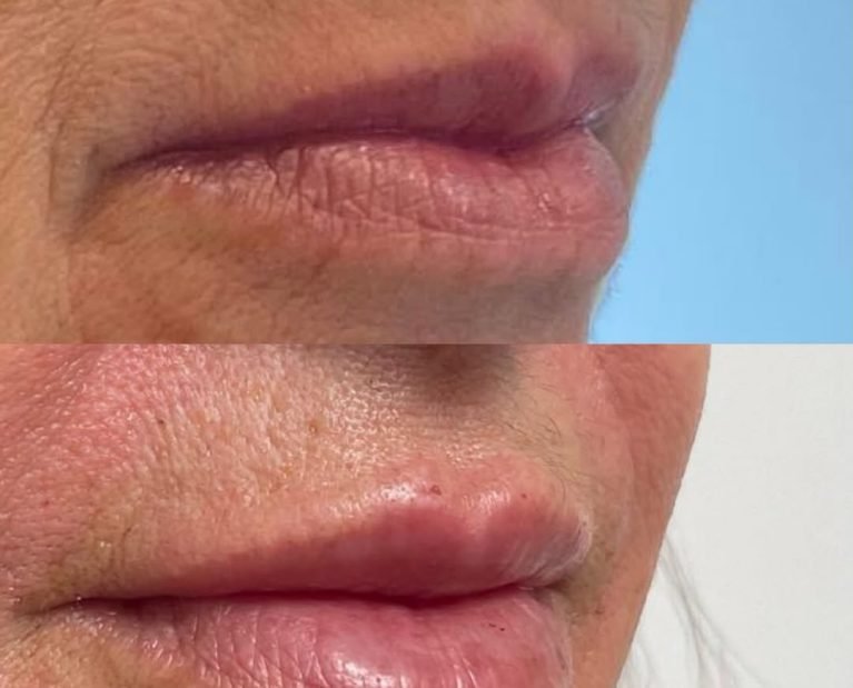 O preenchimento labial vai muito além de volume ele é sobre proporção, harmonia e respeito à ind